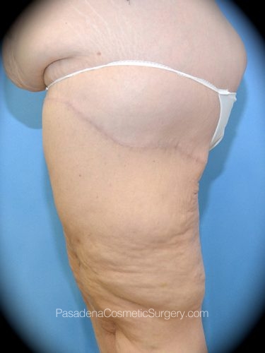 Thighplasty Patient 03 After - 3