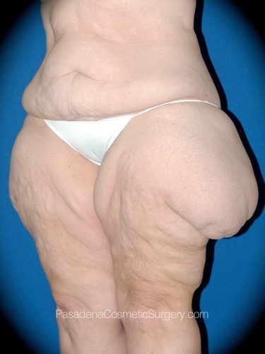 Thighplasty Patient 03 Before - 2