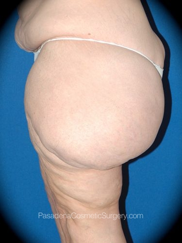 Thighplasty Patient 03 Before - 3