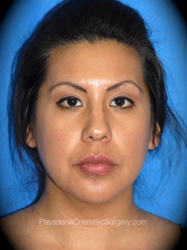 Smart Lipo Patient 05 After