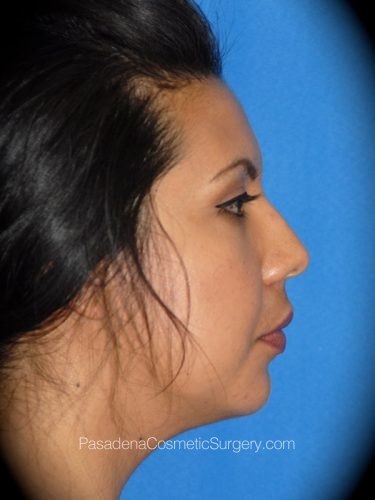 Smart Lipo Patient 05 After - 3