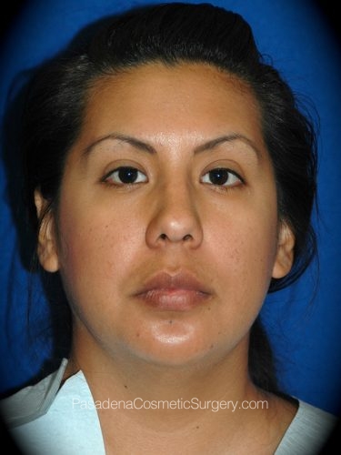 Smart Lipo Patient 05 Before