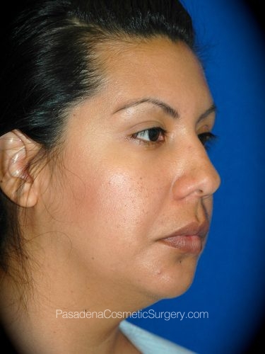 Smart Lipo Patient 05 Before - 2