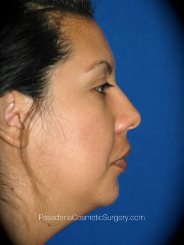 Smart Lipo Patient 05 Before - 3