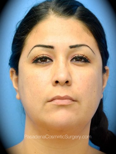 Smart Lipo Patient 04 After