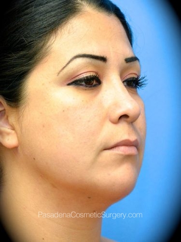 Smart Lipo Patient 04 After - 2