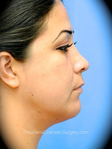 Smart Lipo Patient 04 After - 3