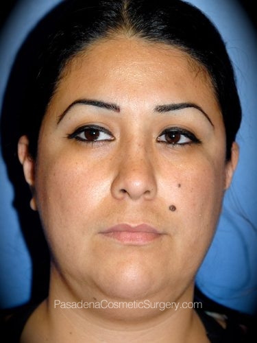 Smart Lipo Patient 04 Before