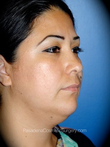 Smart Lipo Patient 04 Before - 2