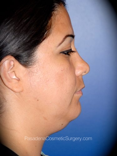 Smart Lipo Patient 04 Before - 3