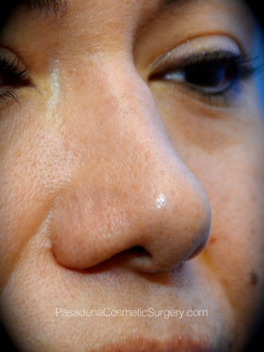 Rhinoplasty Patient 14 After - 2