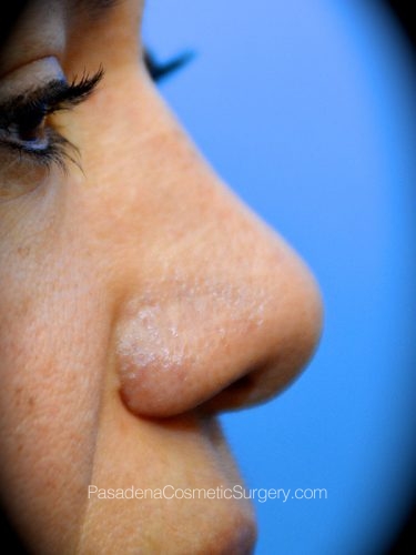 Rhinoplasty Patient 14 After - 3