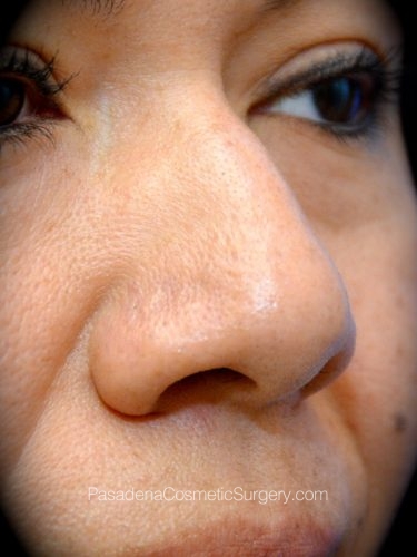 Rhinoplasty Patient 14 Before - 2