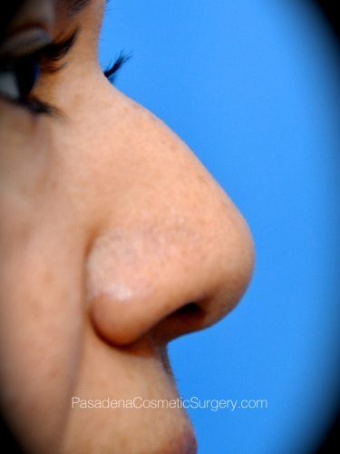 Rhinoplasty Patient 14 Before - 3