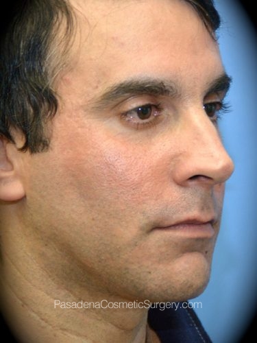 Smart Lipo Patient 06 After - 2