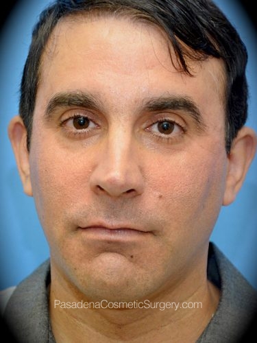 Smart Lipo Patient 06 Before