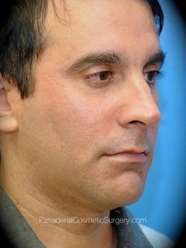 Smart Lipo Patient 06 Before - 2