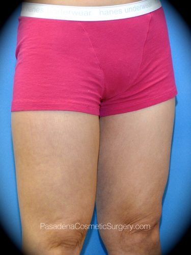 Thighplasty Patient 04 After - 2