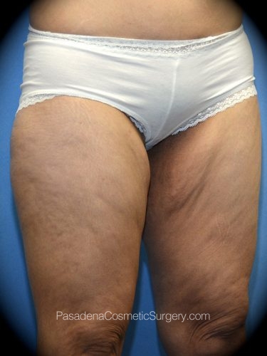 Thighplasty Patient 04 Before - 2