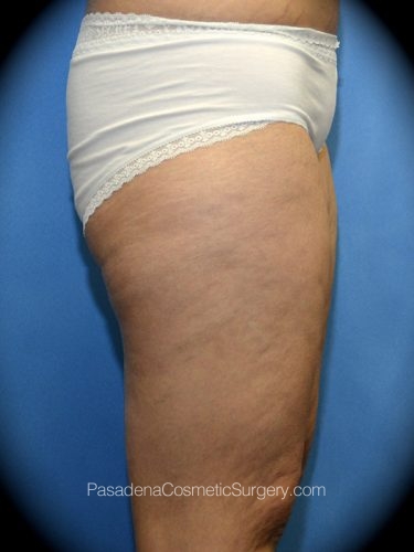 Thighplasty Patient 04 Before - 3