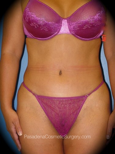Tummy Tuck Patient 16 After