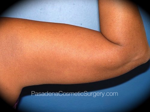 Smart Lipo Patient 07 After - 2