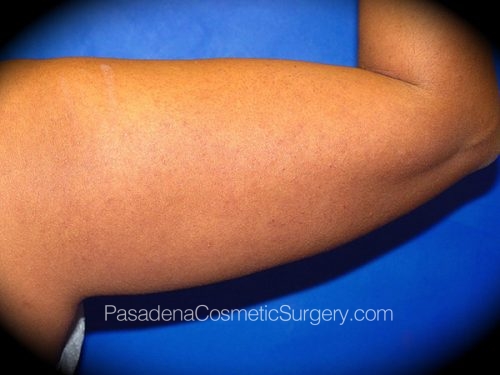 Smart Lipo Patient 07 Before - 2