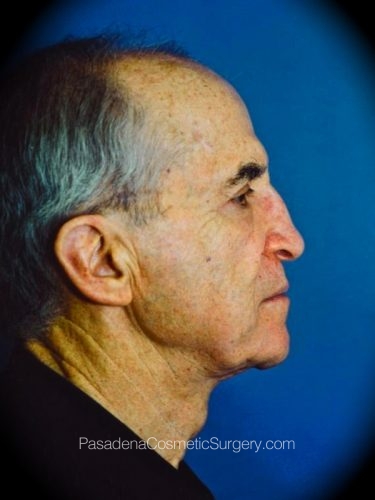 Neck Lift Patient 05 After - 2