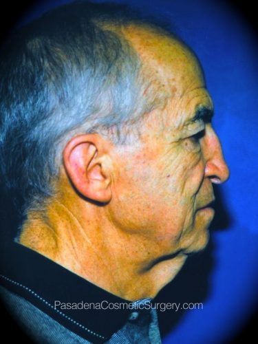 Neck Lift Patient 05 Before - 2