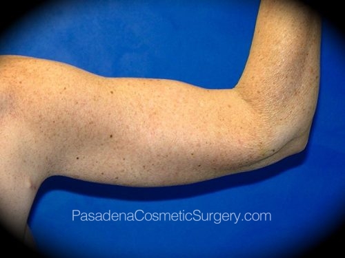 Arm Lift Patient 03 After - 2