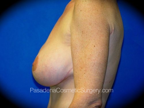 Breast Augmentation with Mastopexy Patient 01 After - 3