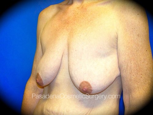 Breast Augmentation with Mastopexy Patient 01 Before - 2