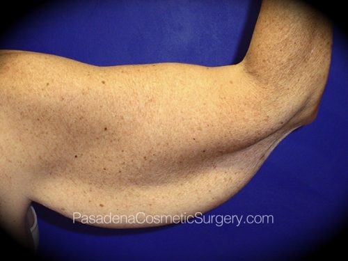 Arm Lift Patient 03 Before - 2