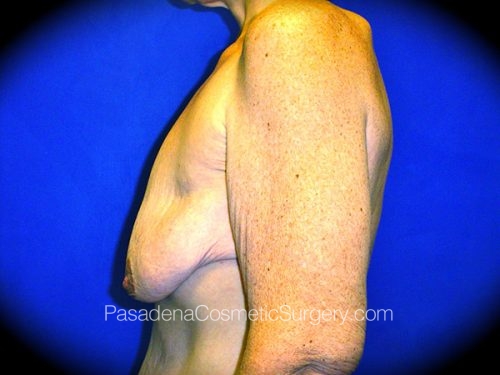 Breast Augmentation with Mastopexy Patient 01 Before - 3