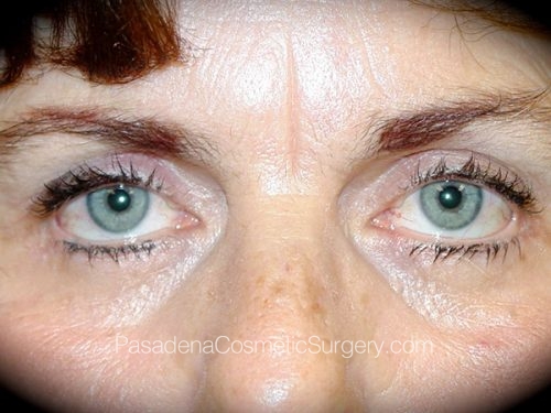 Eyelid Surgery Patient 01 After