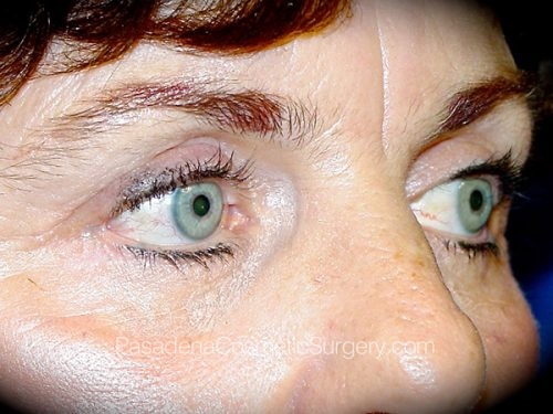 Eyelid Surgery Patient 01 After - 2
