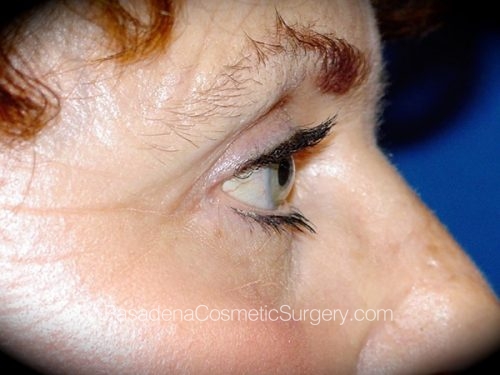 Eyelid Surgery Patient 01 After - 3