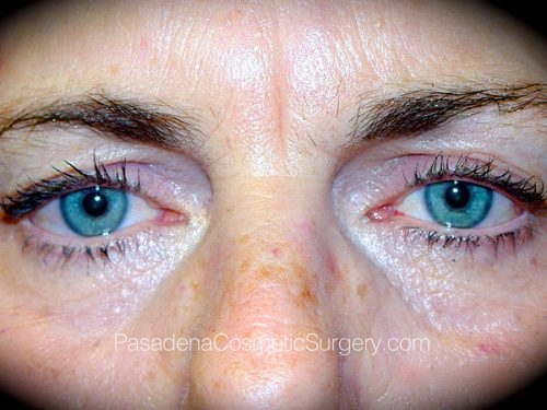 Eyelid Surgery Patient 01 Before