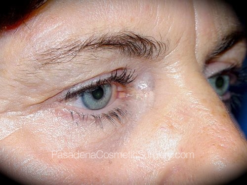 Eyelid Surgery Patient 01 Before - 2
