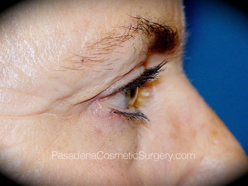 Eyelid Surgery Patient 01 Before - 3