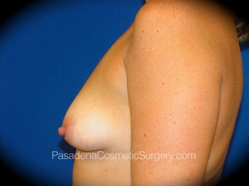 Breast Augmentation Patient 02 Before