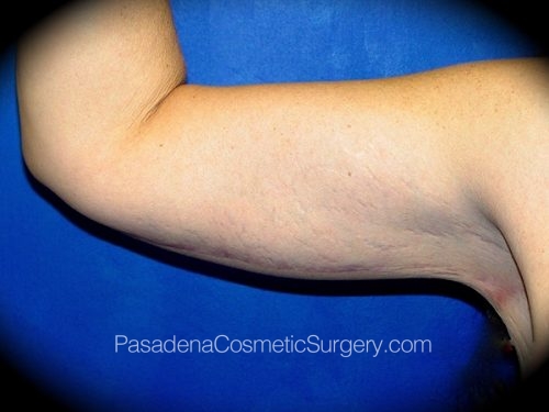 Arm Lift Patient 01 After