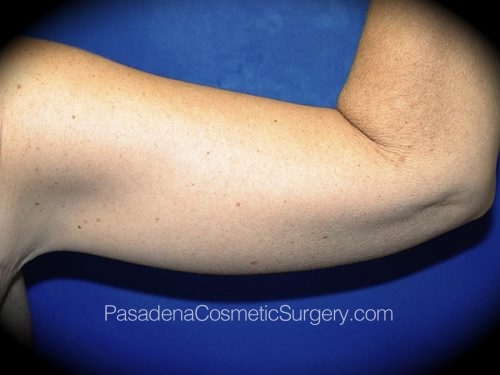 Arm Lift Patient 01 After - 2