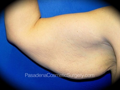 Arm Lift Patient 01 Before