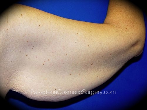 Arm Lift Patient 01 Before - 2