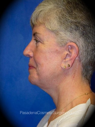 Facelift Patient 02 After - 3