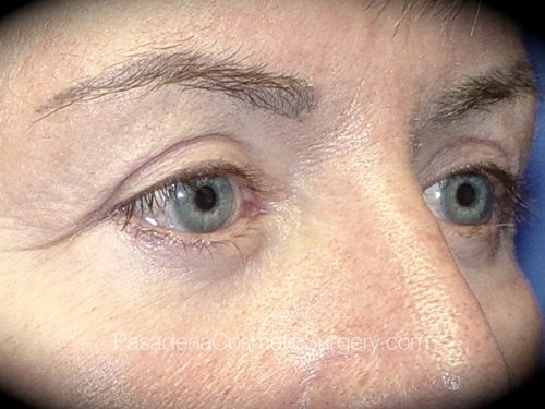 Eyelid Surgery Patient 02 After - 2