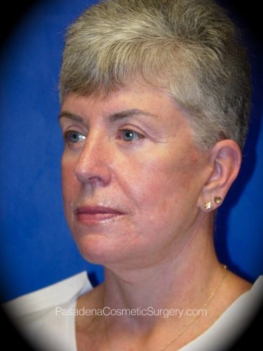 Facelift Patient 02 After - 2