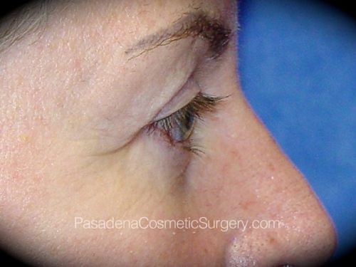 Eyelid Surgery Patient 02 After - 3