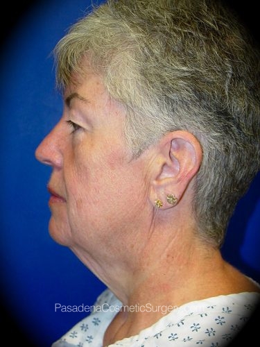 Facelift Patient 02 Before - 3